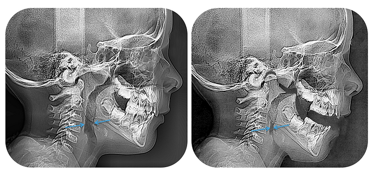 Effects of mouth breathing on airway